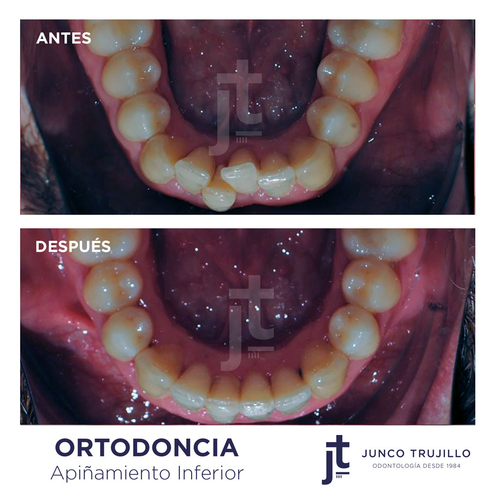 ortodoncia-apiñamiento