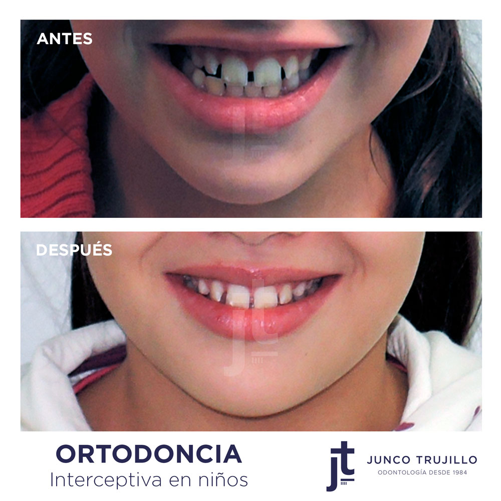 ortodoncia-interperceptiva