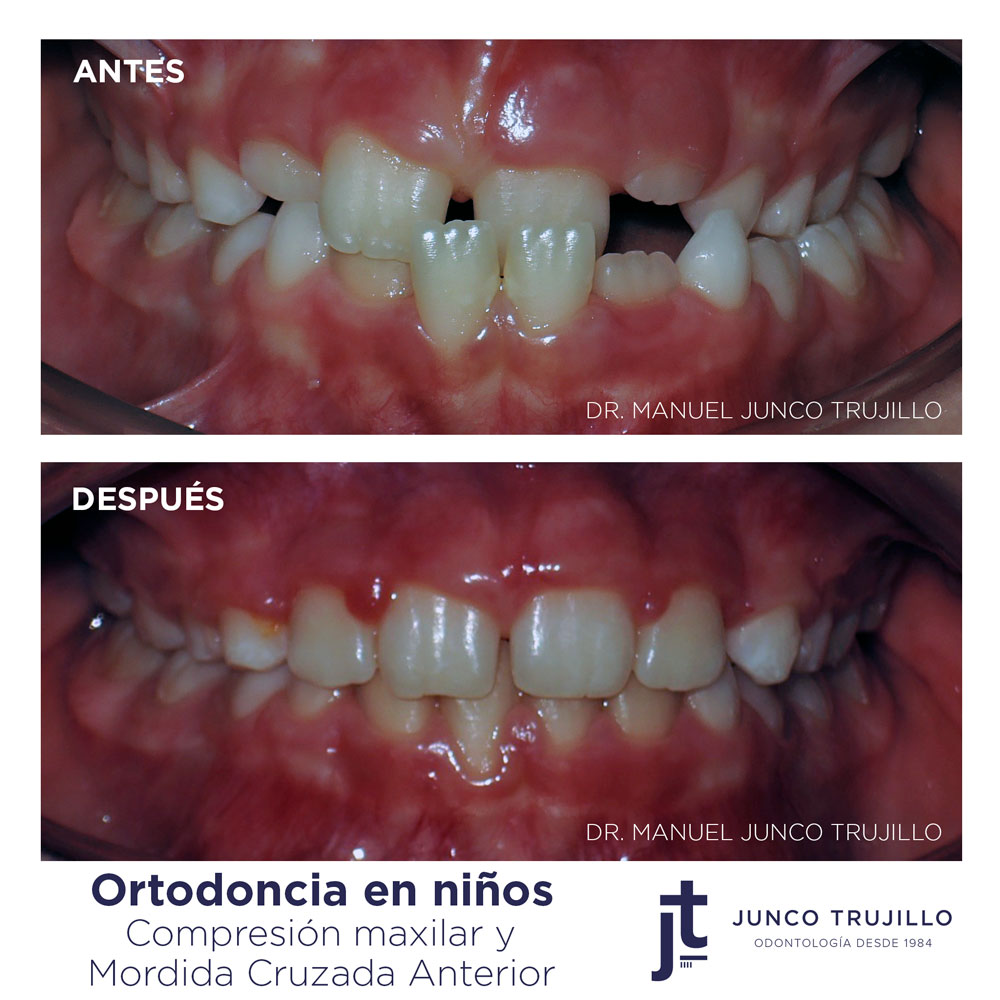 ortodoncia-en-ninos-palencia