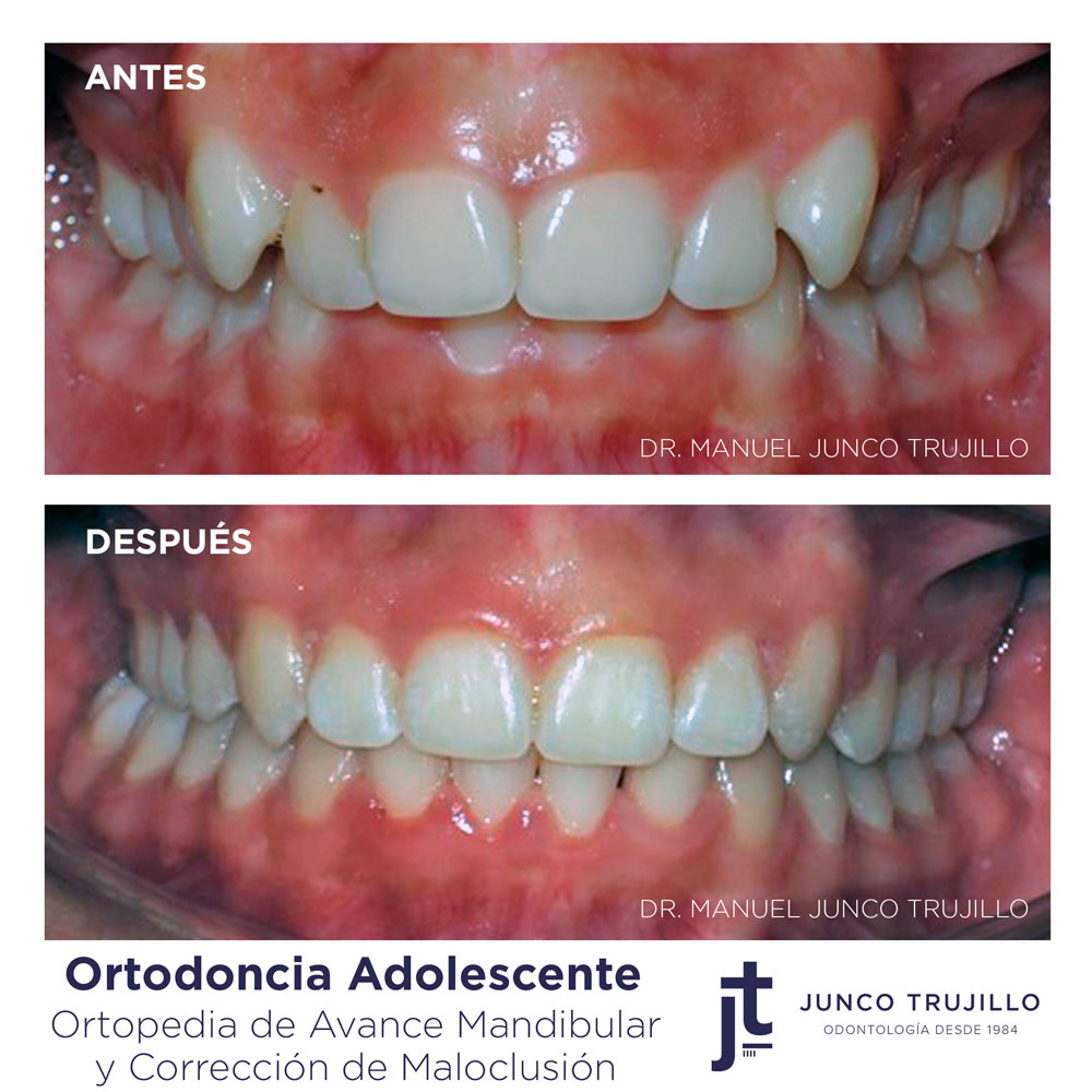 Ortodoncia-adolescente-en-palencia