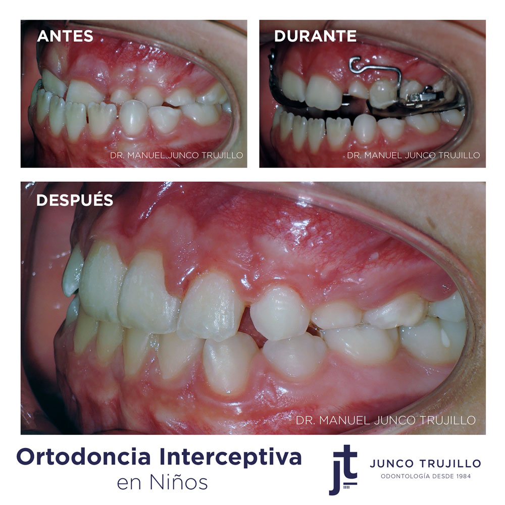 ortodoncia-infantil