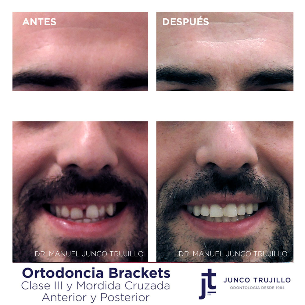 caso-ortodoncia-brackets