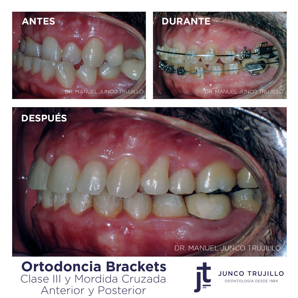ortodoncia-con-brackets-dental-junco