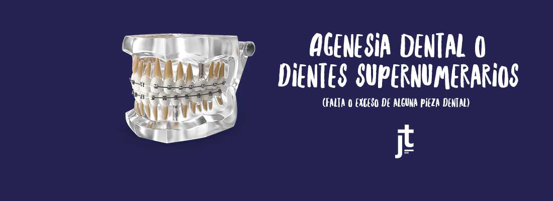 agenesias-dentales-supernumerarios