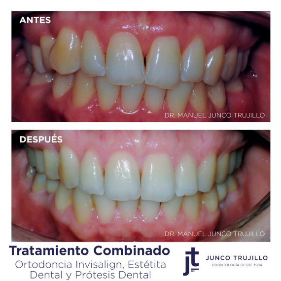 Protesis-dental-en-Palencia