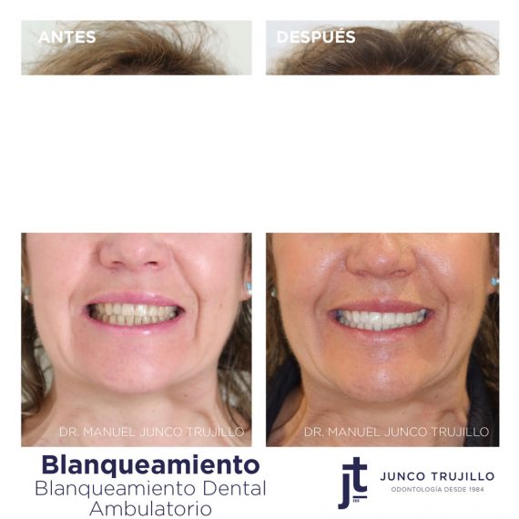 blanqueamiento-ambulatorio-mayores-palencia
