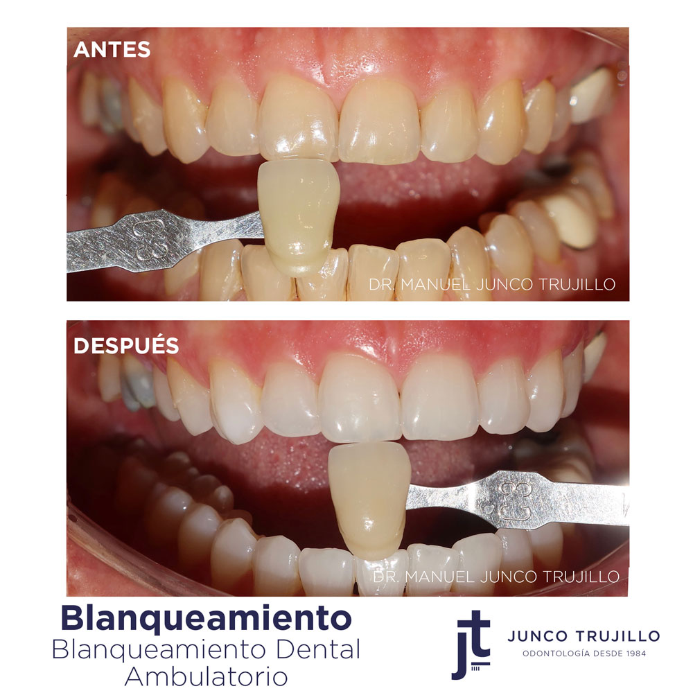 blanqueamiento-dental-en-mayores