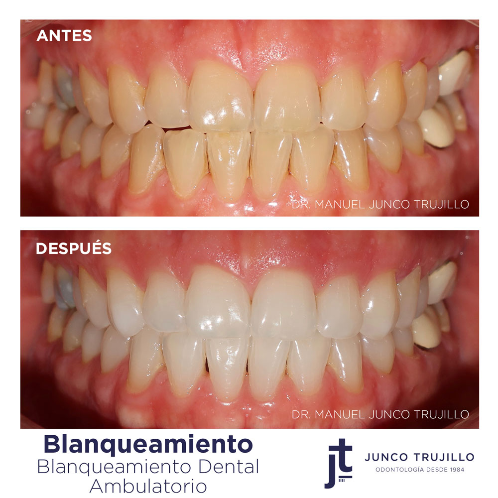 blanqueamiento-dental-en-palencia