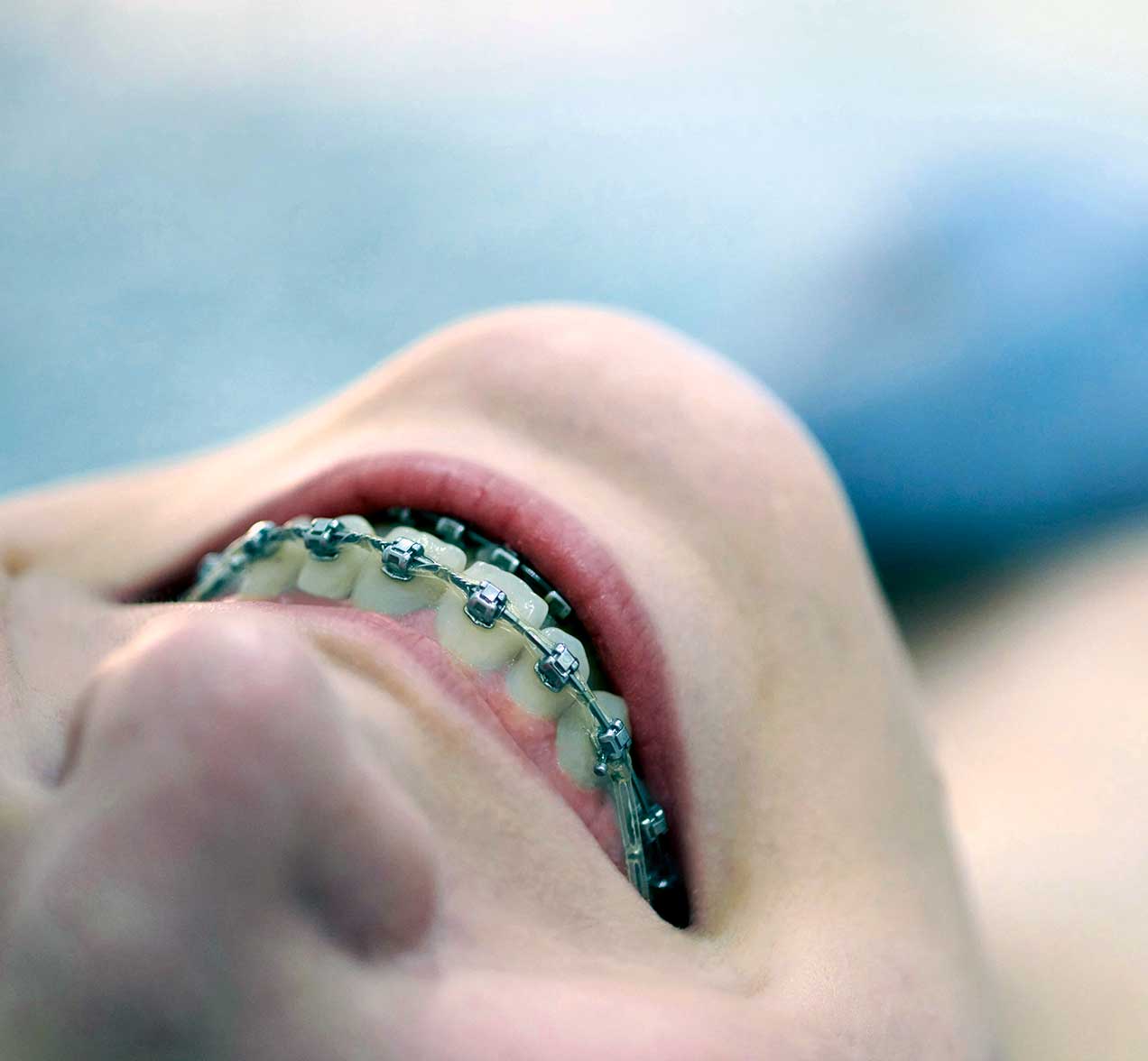 brackets-metalicos-en-palencia