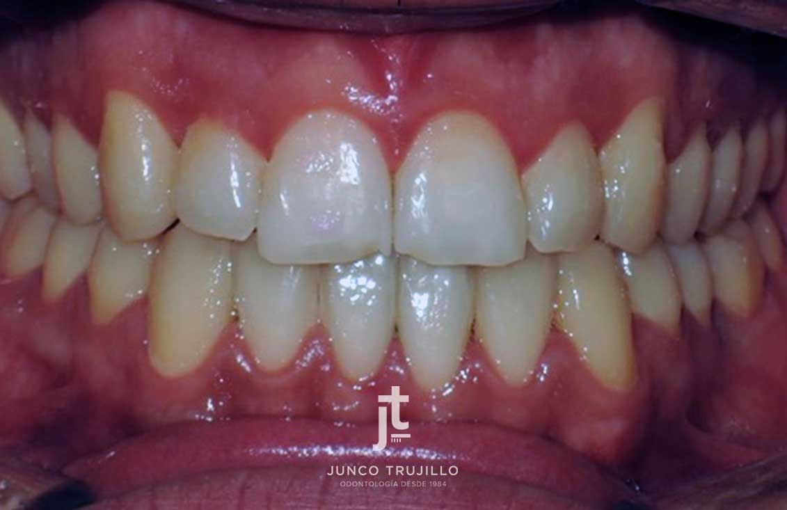 carillas-composite-en-palencia-2