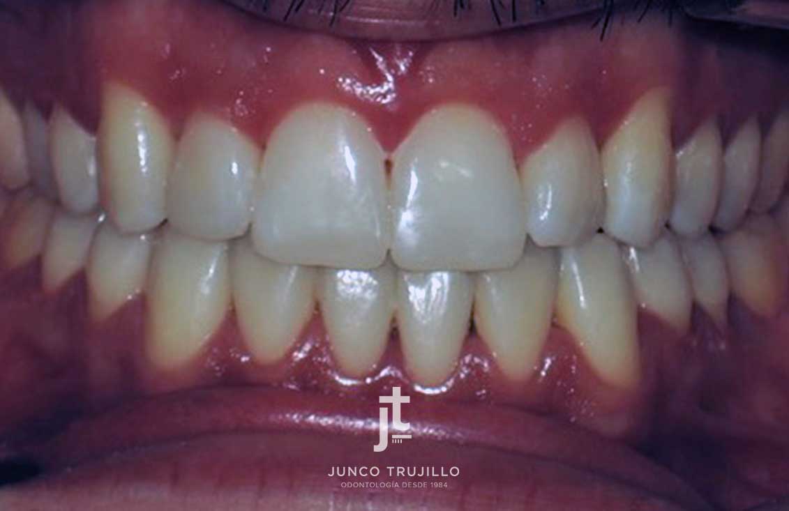 carillas-composite-en-palencia