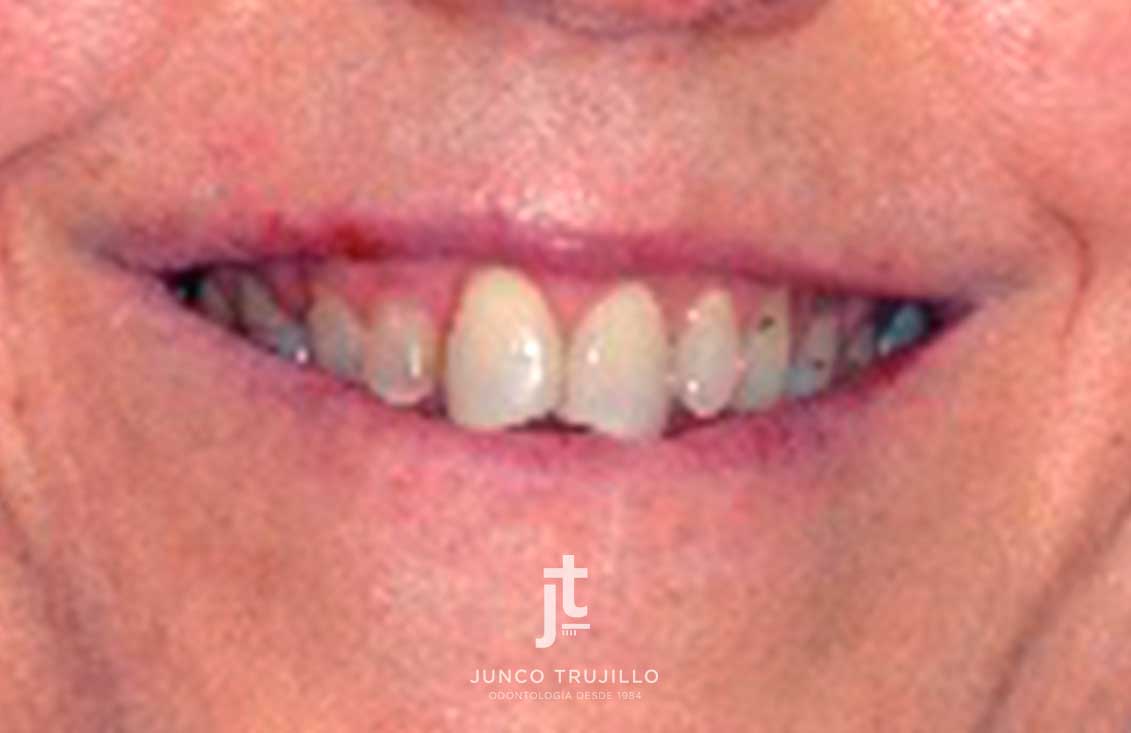 caso-carillas-en-palencia-2