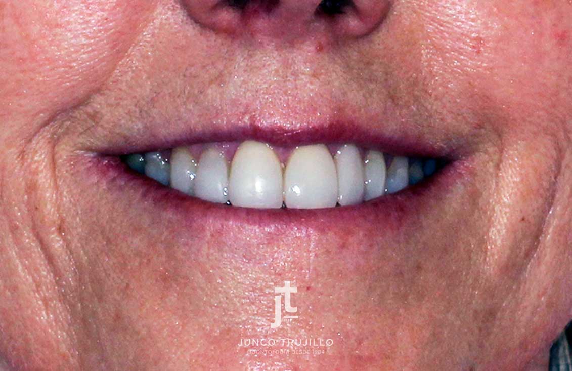 caso-carillas-en-palencia