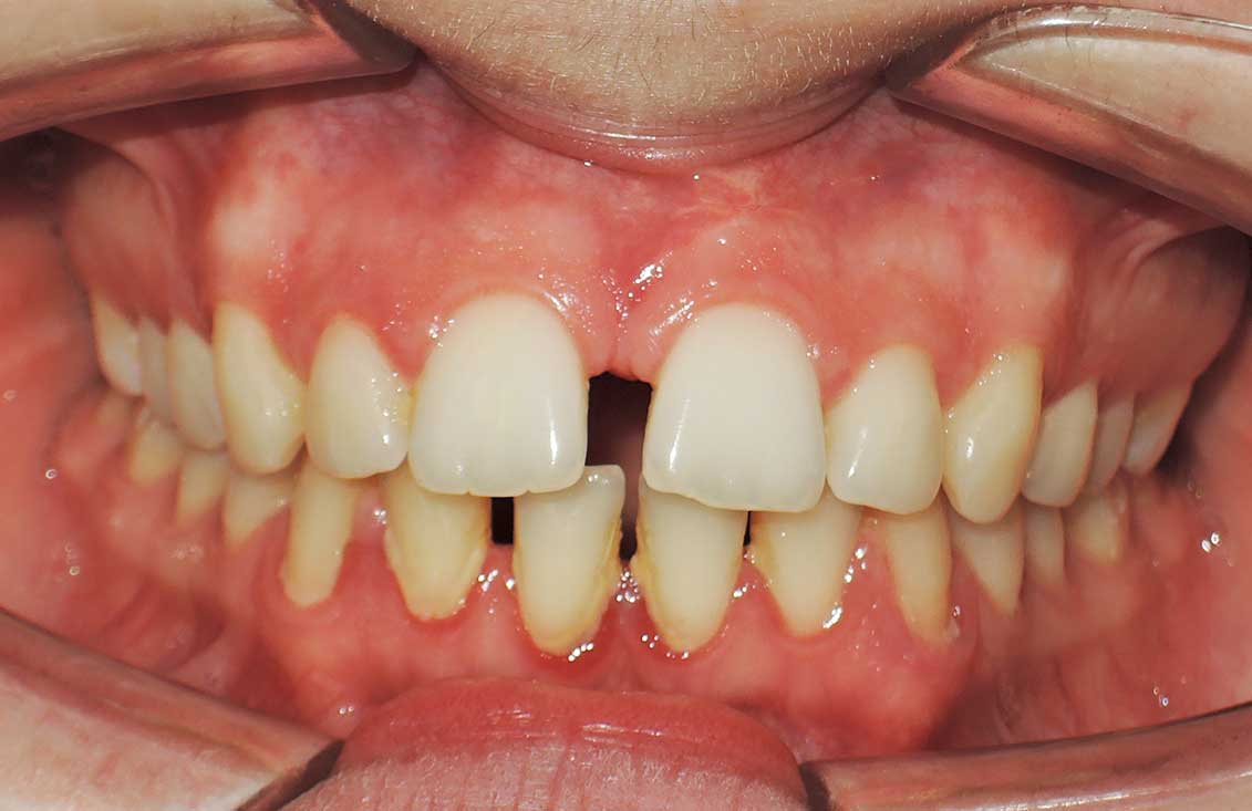 caso-invisalign-en-palencia1