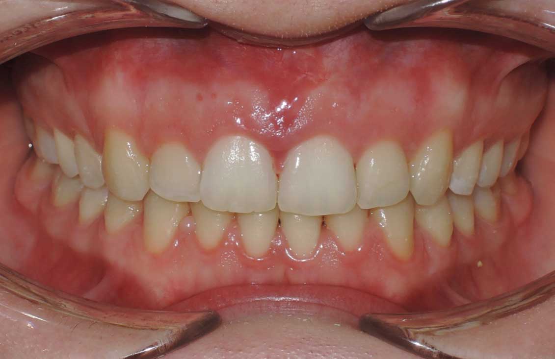 caso-invisalign-en-palencia2