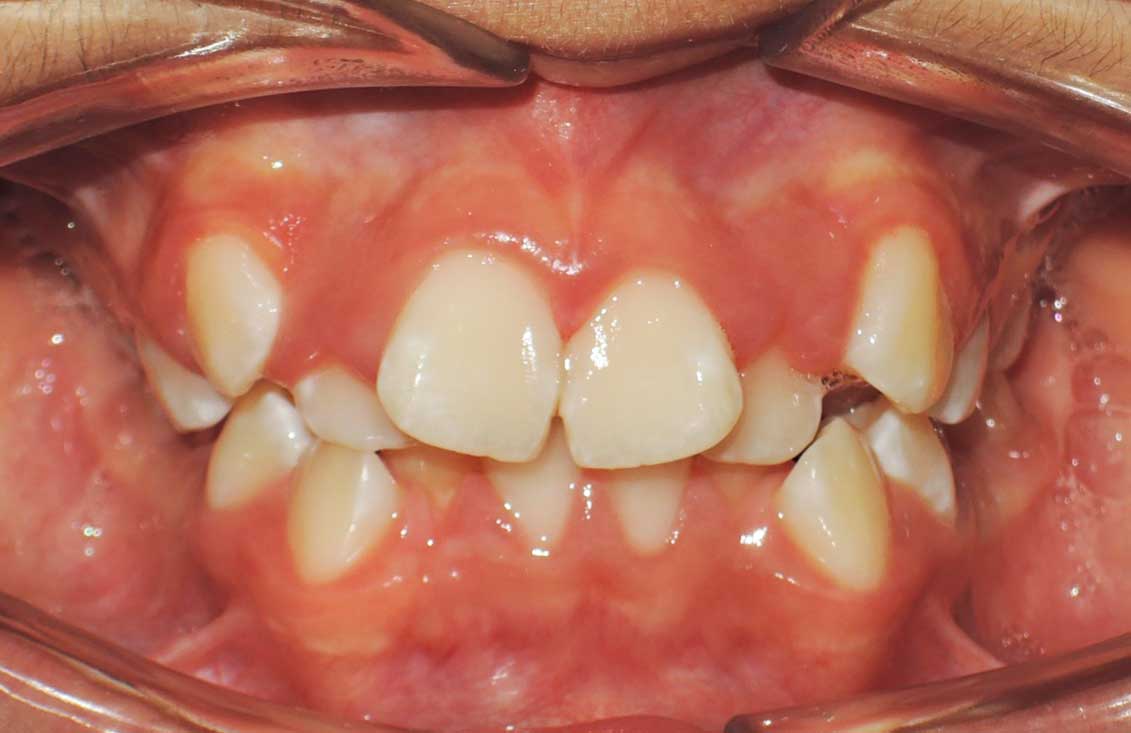 caso-ortopedia-ortodoncia-en-palencia1