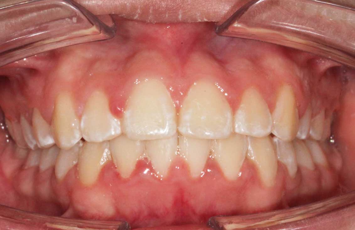 caso-ortopedia-ortodoncia-en-palencia2
