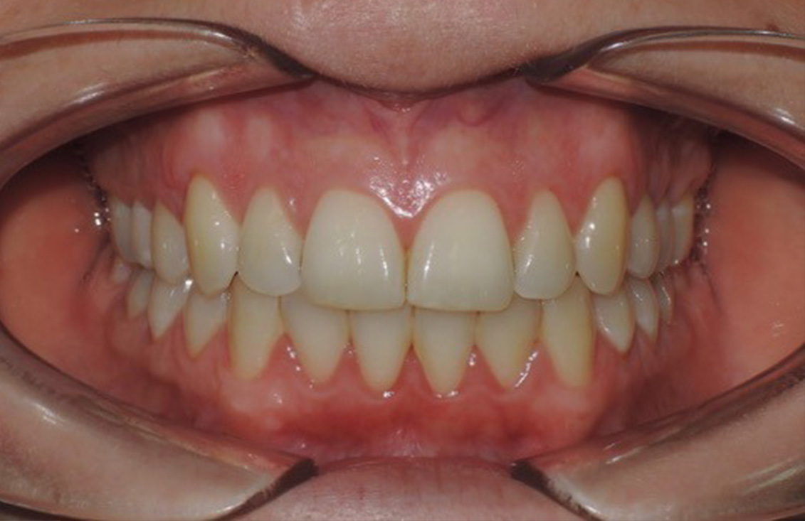 ejemplo-blanqueamiento-dental-palencia