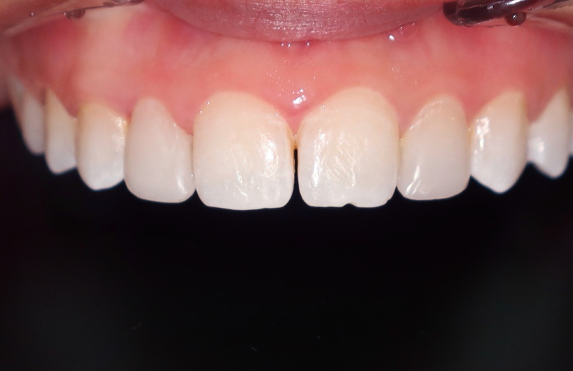 ejemplo-blanqueamiento-dental-palencia03-b