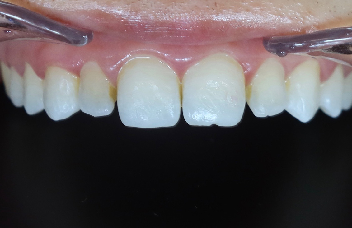 ejemplo-blanqueamiento-dental-palencia03