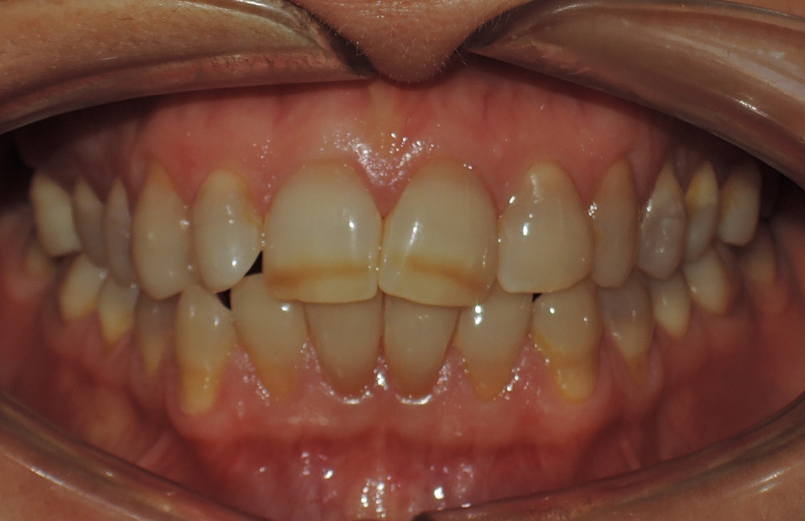 ejemplo-blanqueamiento-dental-palencia04