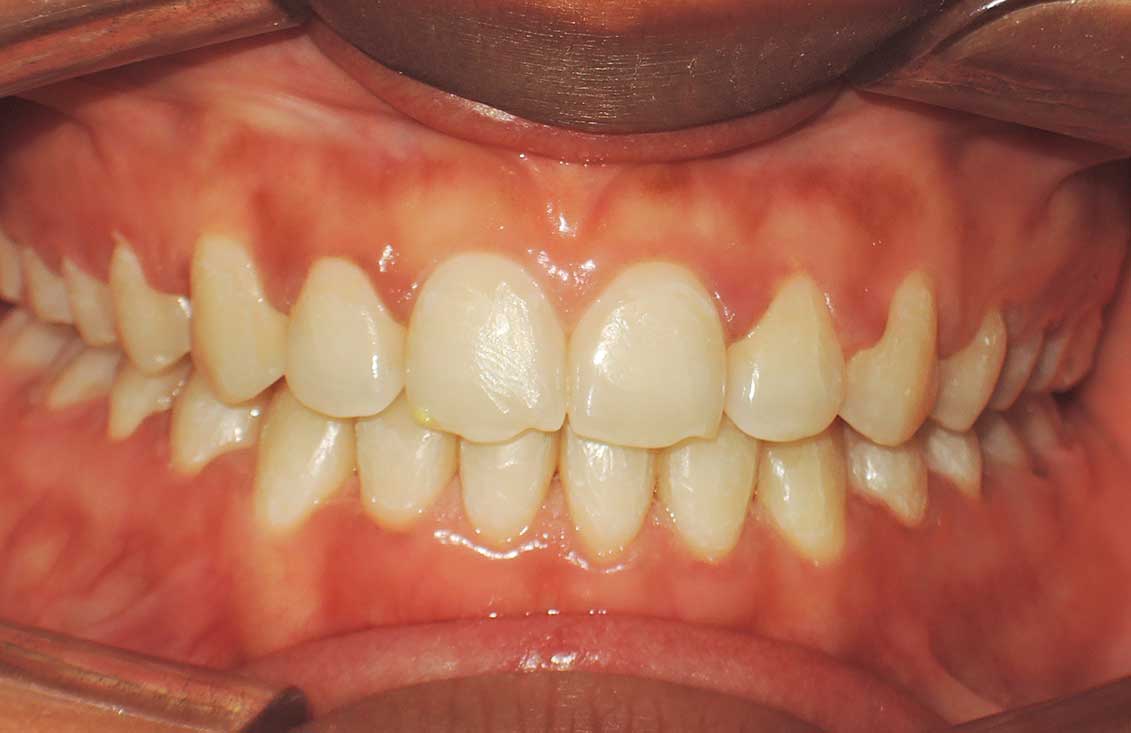 ejemplo-brackets-en-palencia-2