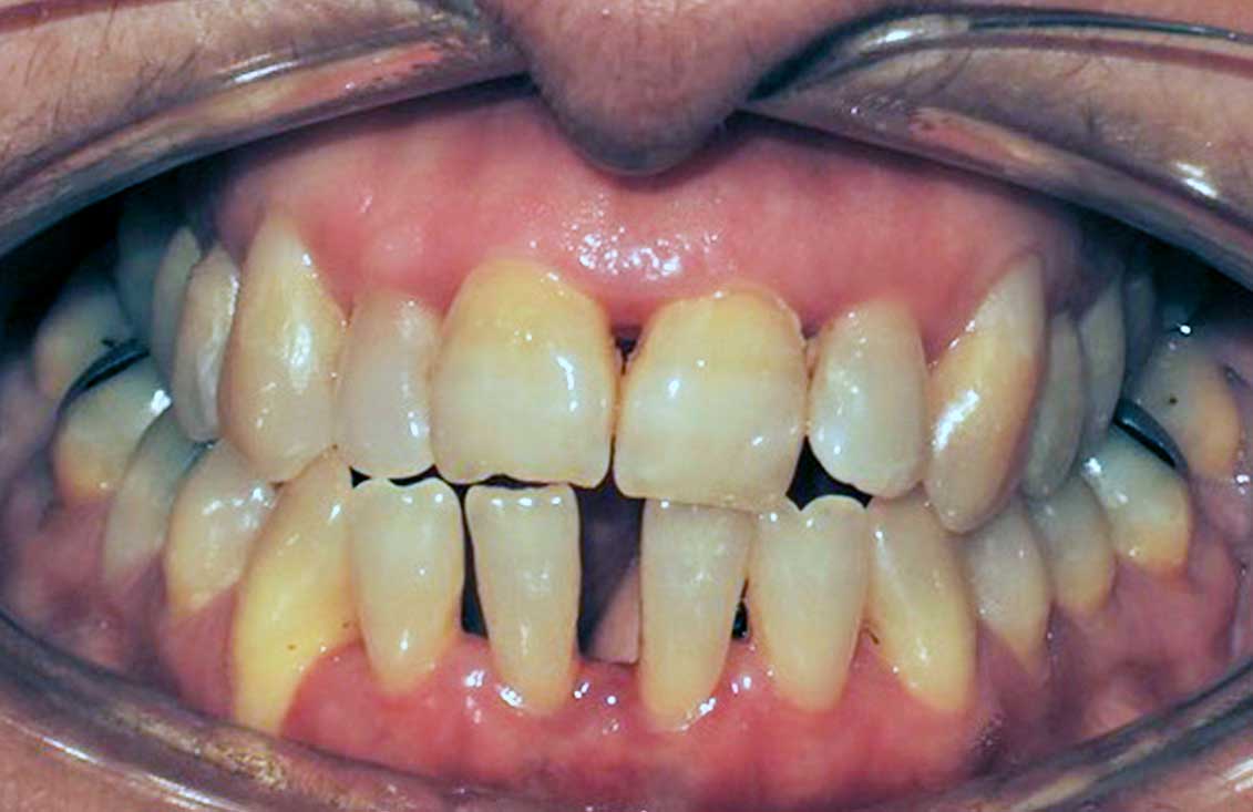 ejemplo-invisalign-1