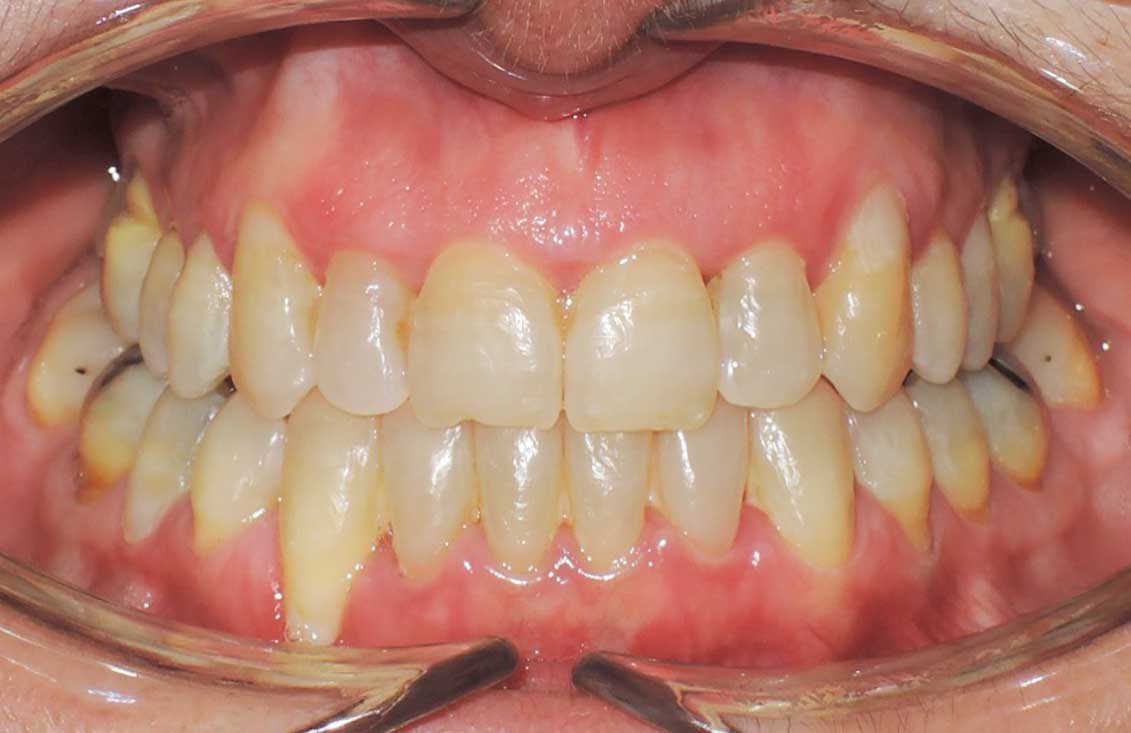 ejemplo-invisalign-2