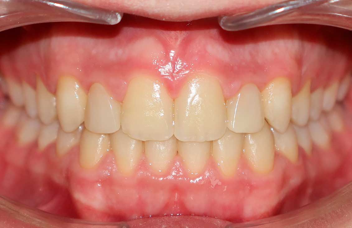 ejemplo1-ortodoncia-2