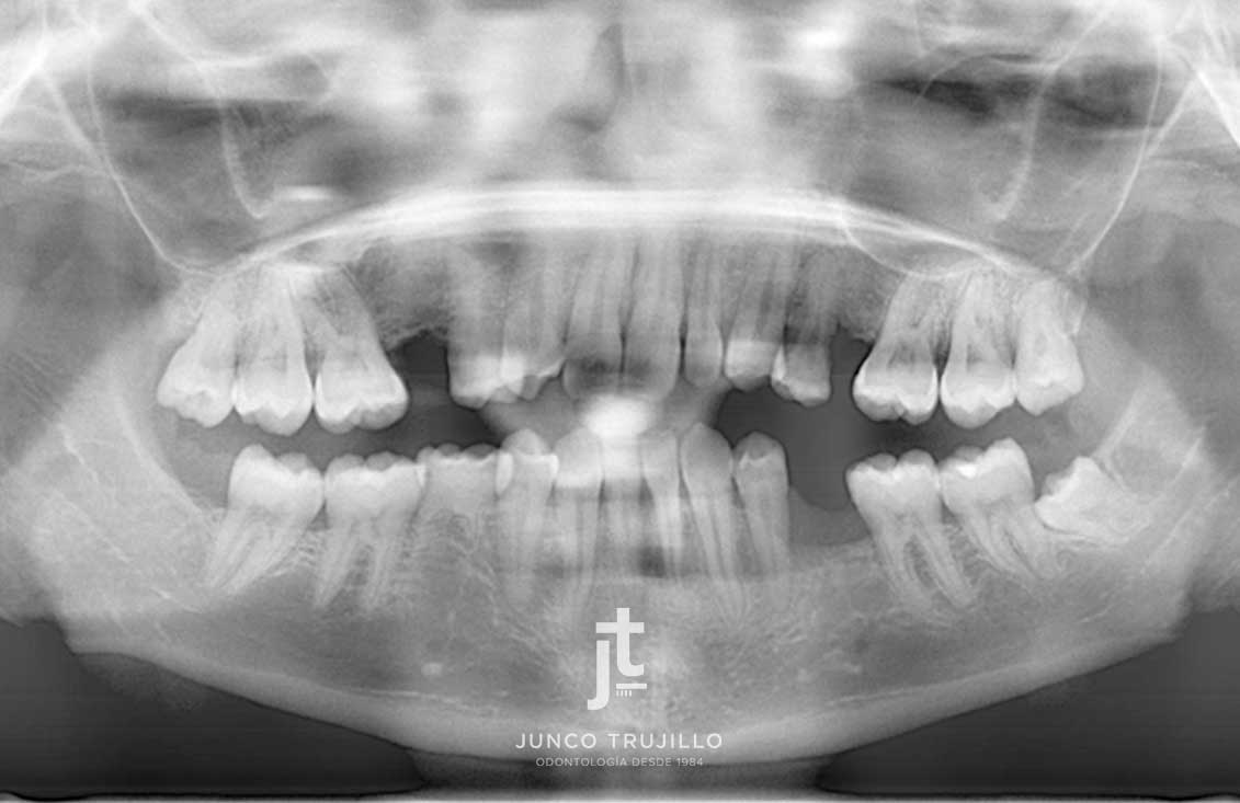 escaner-implante-dental