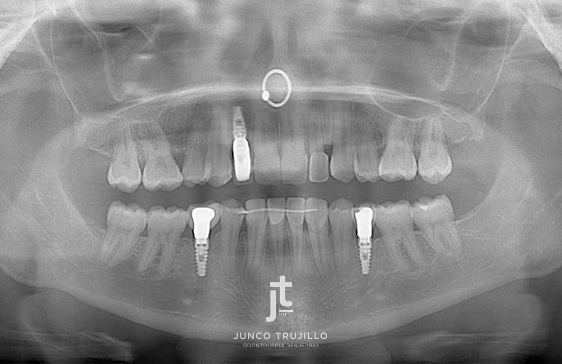 escaner-laboratorio-dental