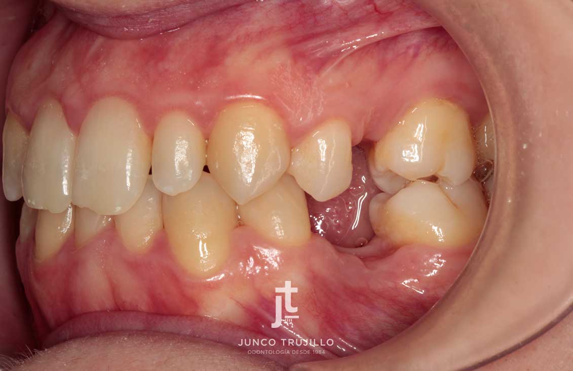 implante-en-palencia-2