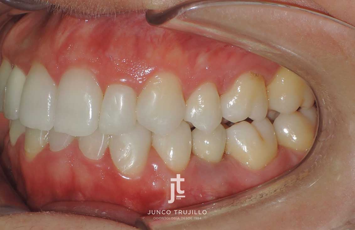 implante-en-palencia