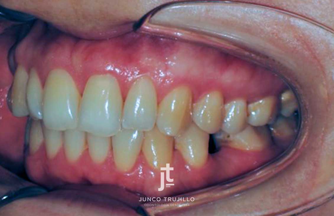 implantes-en-palencia