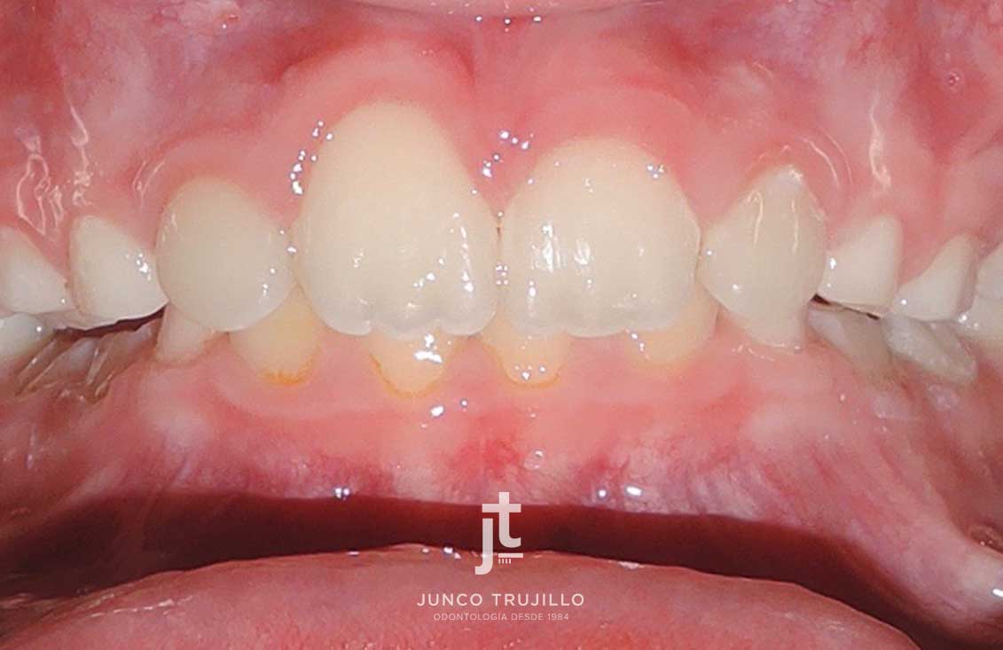 invisalign-first-en-palencia2