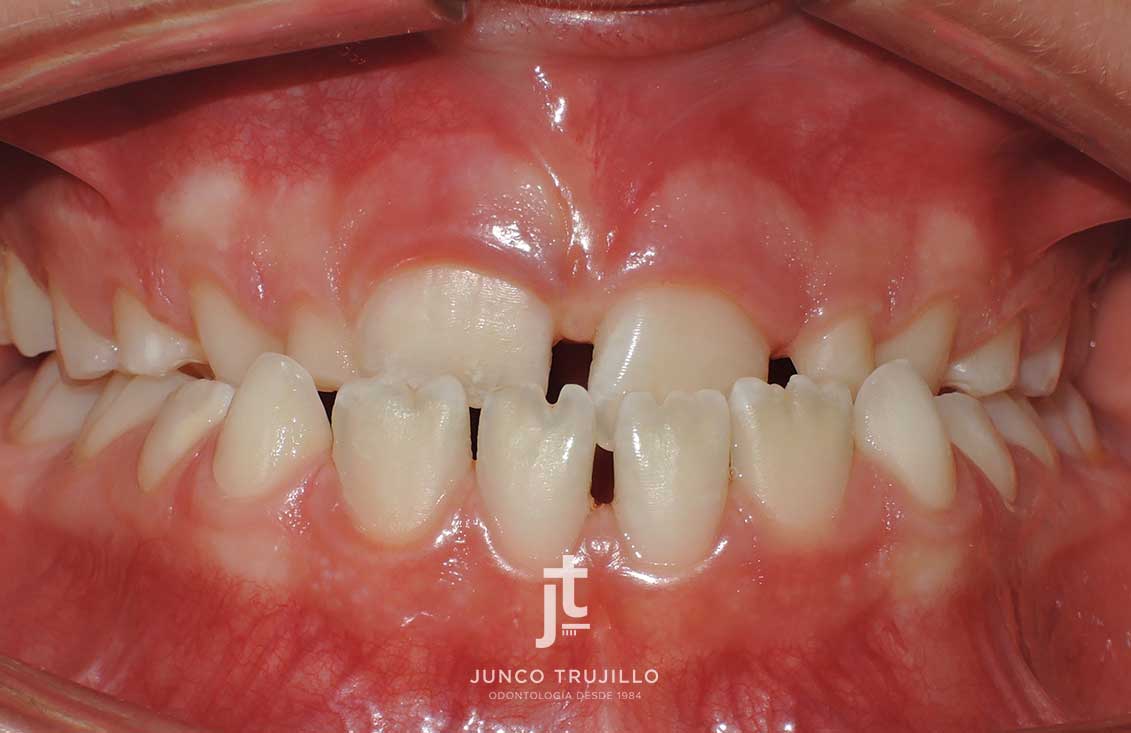 ortodoncia-interceptiva-odontopediatria-2