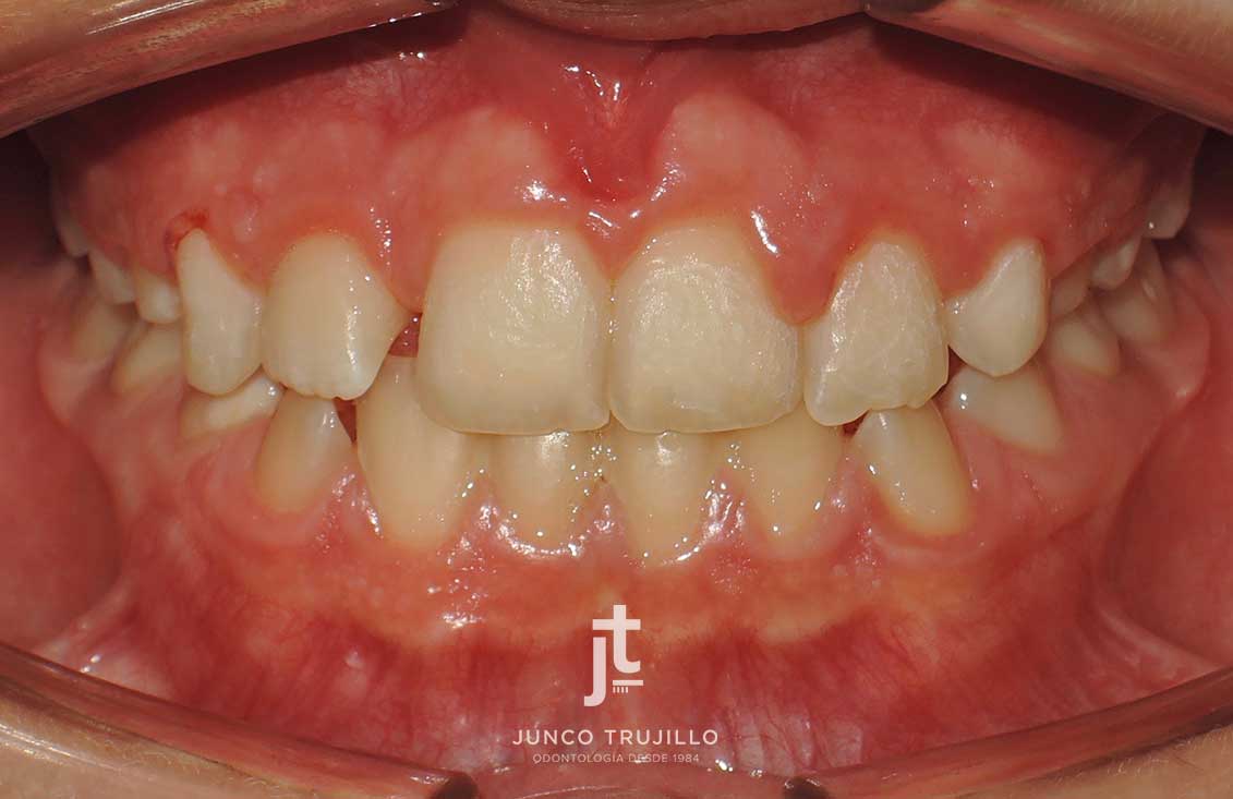 ortodoncia-interceptiva-odontopediatria