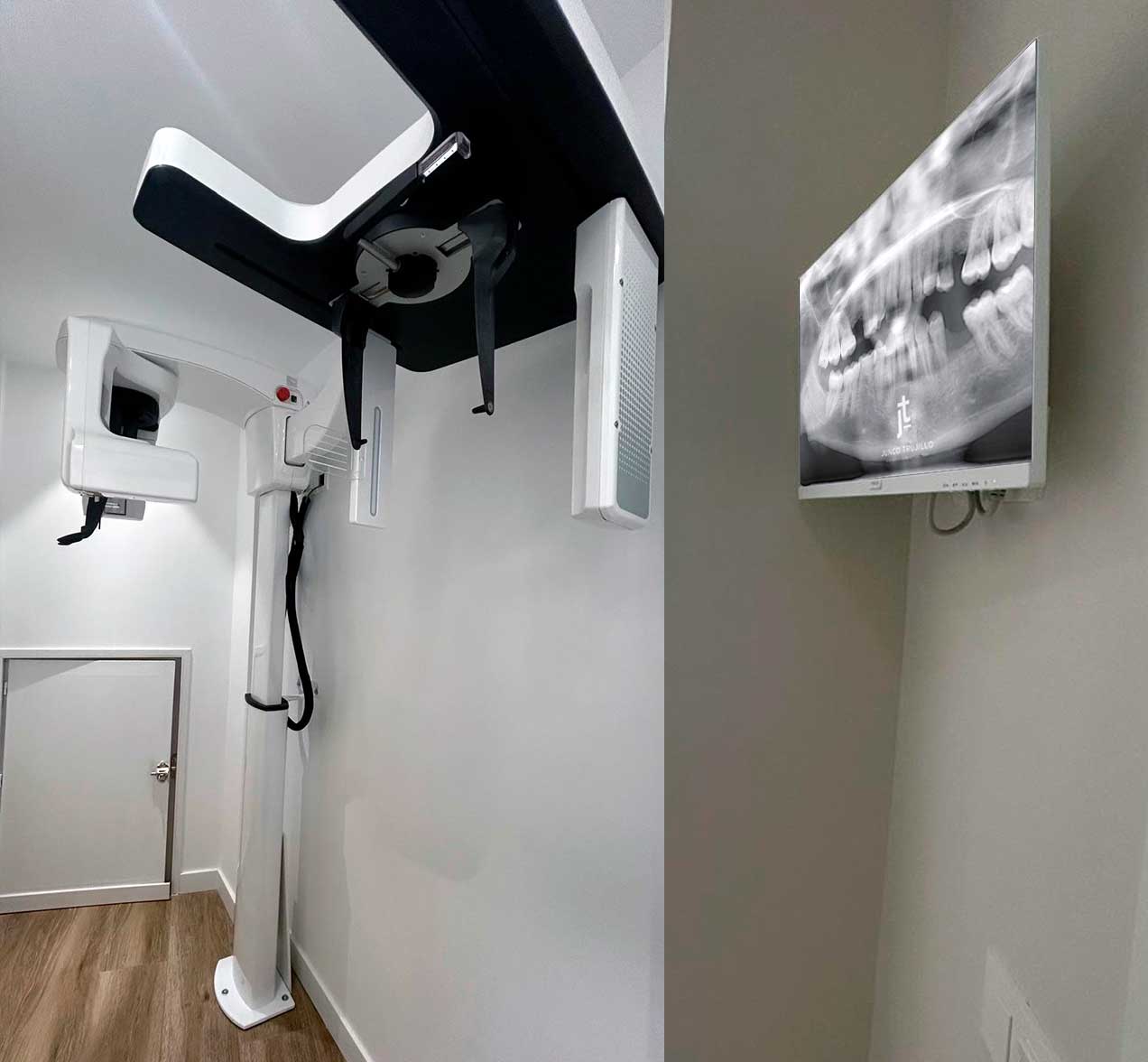 radiografia-implantes-palencia