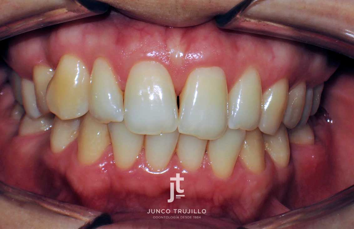 Tratamiento-combinado-con-ortodoncia-invisible-e-implantes-dentales