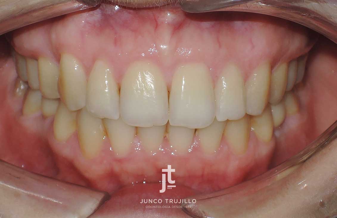 Tratamiento-combinado-con-ortodoncia-invisible-e-implantes-dentales