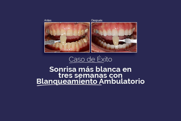Sonrisa más blanca con blanqueamiento ambulatorio
