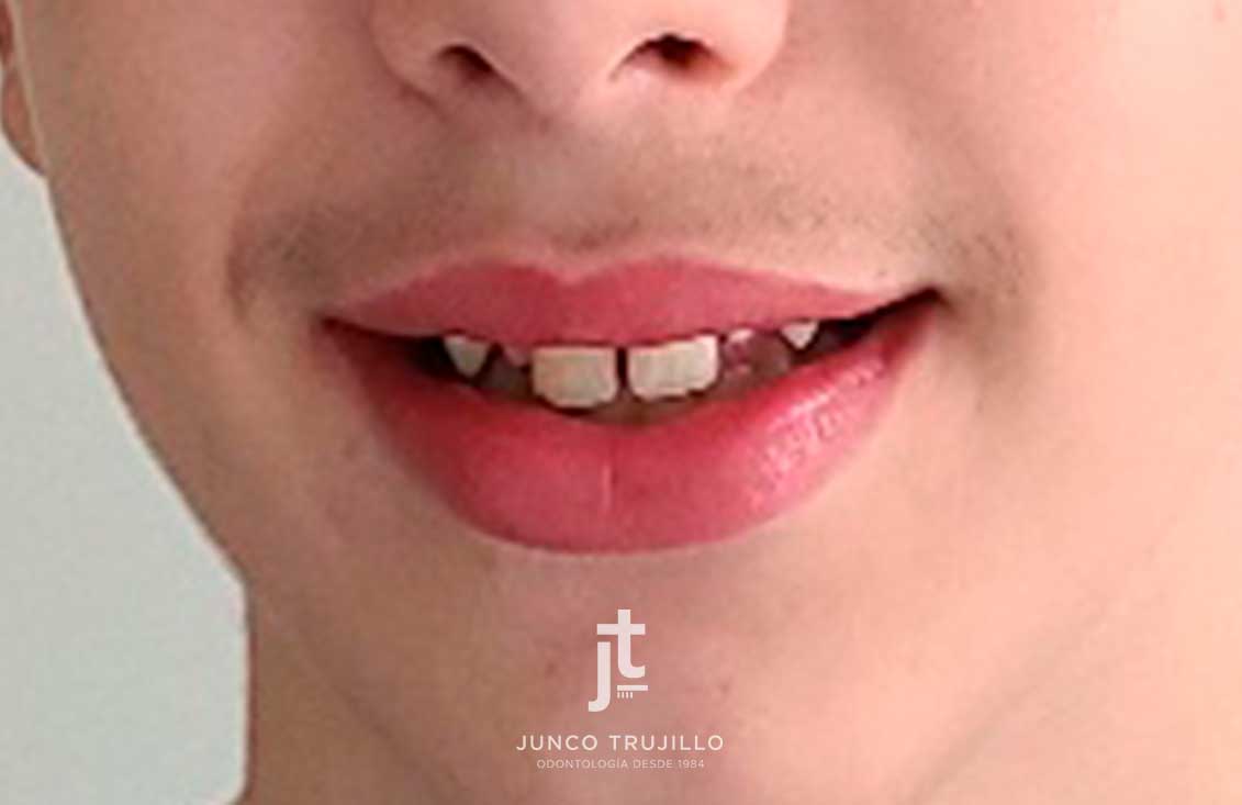 caso-exito-adolescentes-invisalign-2