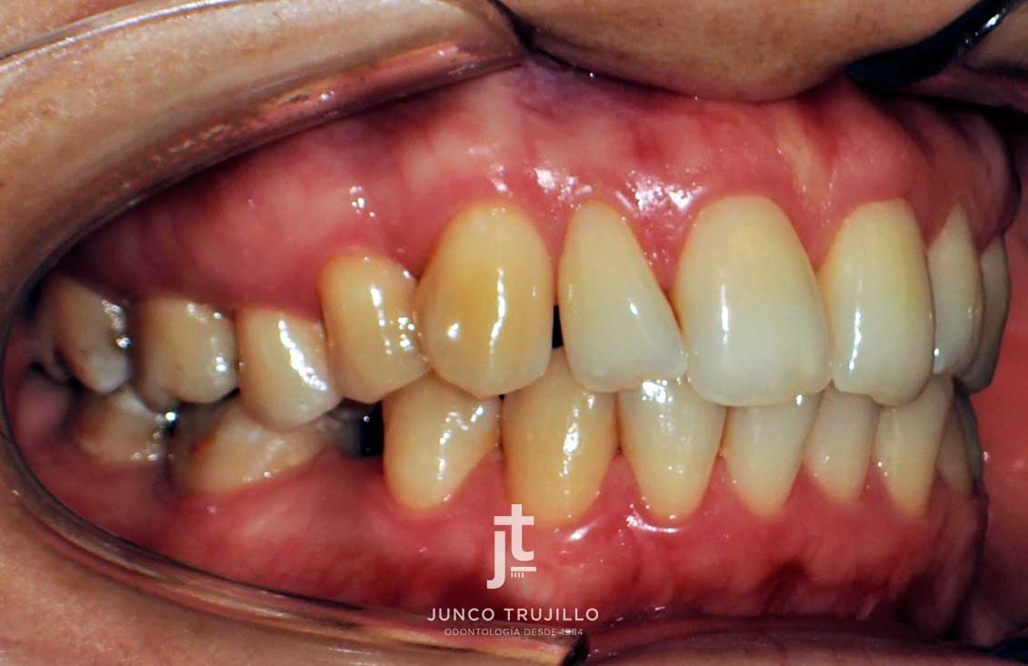 caso-exito-implantes-en-palencia-2