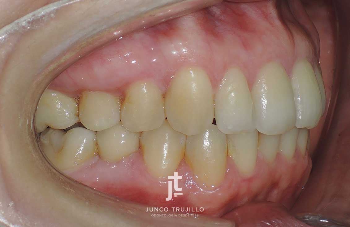 caso-exito-implantes-en-palencia