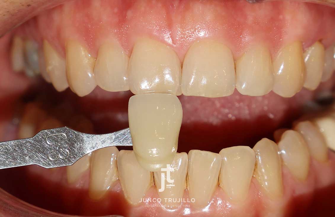 ejemplo-blanqueamiento-en-palencia-1-2