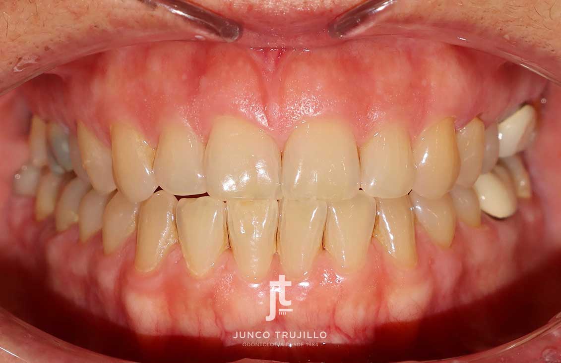 ejemplo-blanqueamiento-en-palencia-3-2