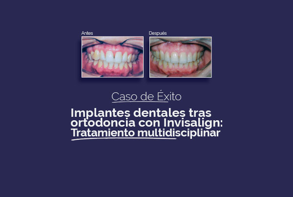 Implantes dentales tras ortodoncia con Invisalign