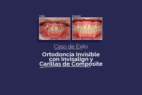 Pacientes adolescentes: ortodoncia invisible con invisalign y carillas de composite