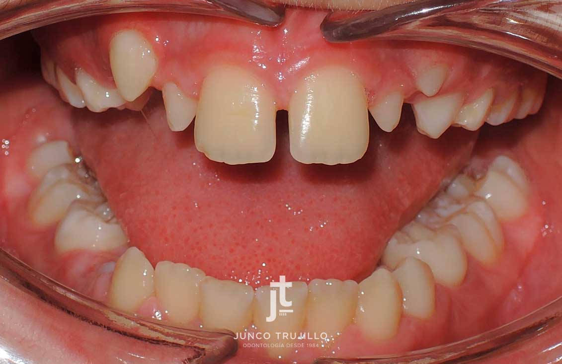 ortodoncia-invisible-adolescentes-2