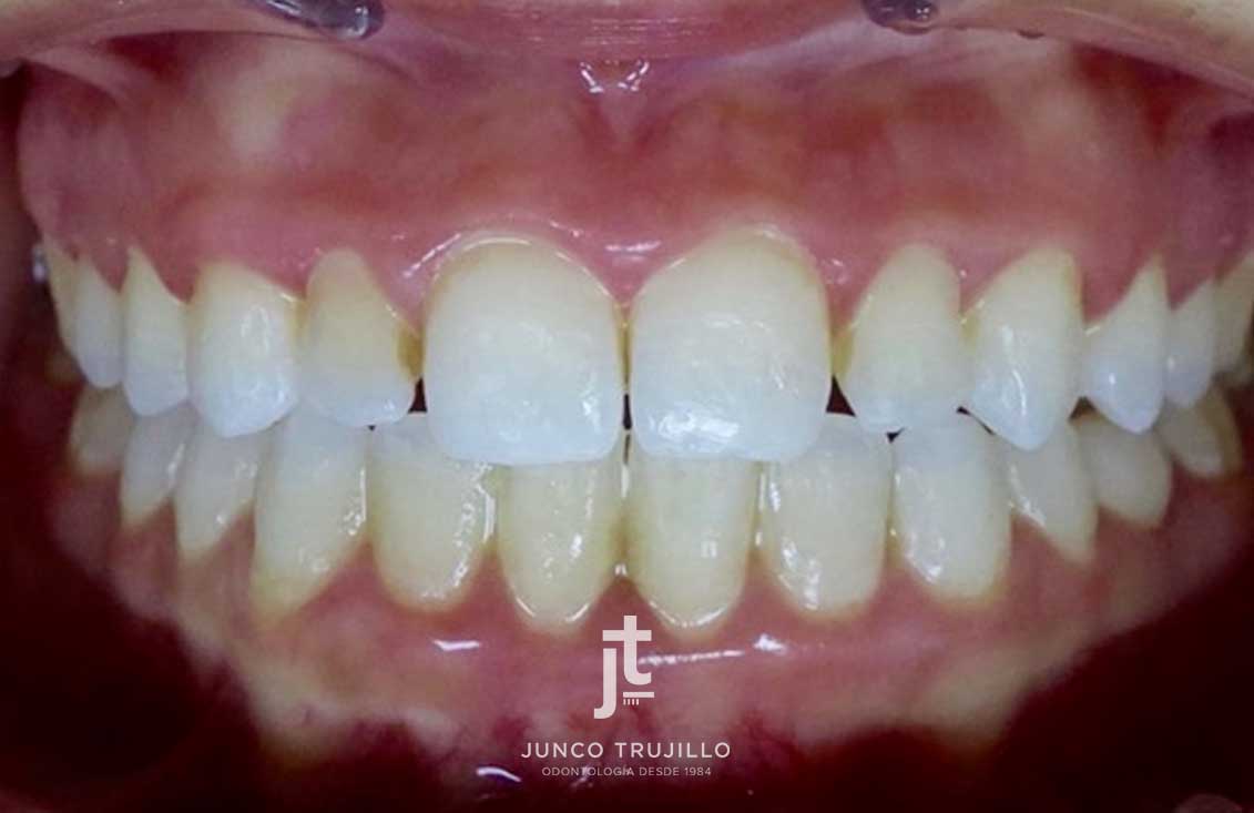 Comparativa-microdoncia-1